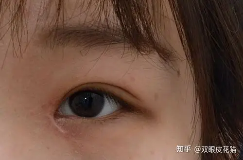 下侧增生上侧增生疤痕的位置有这些,开眼角疤痕是挛缩疤痕(一种广泛软