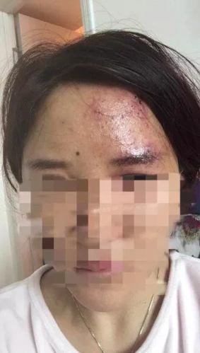 两女子网购玻尿酸互相注射 一针下去差点失明