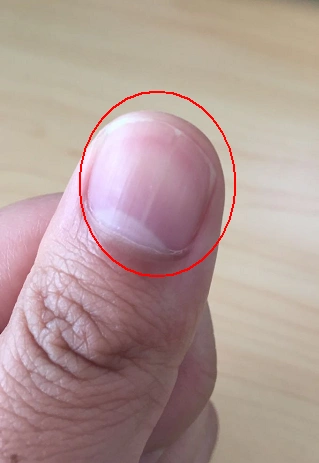 指甲缝局部也有凸出的白条可见.