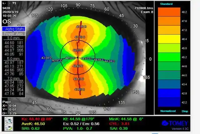 从地形图发现双眼角膜散光大于300度,但基本是上下对称的角膜形态.