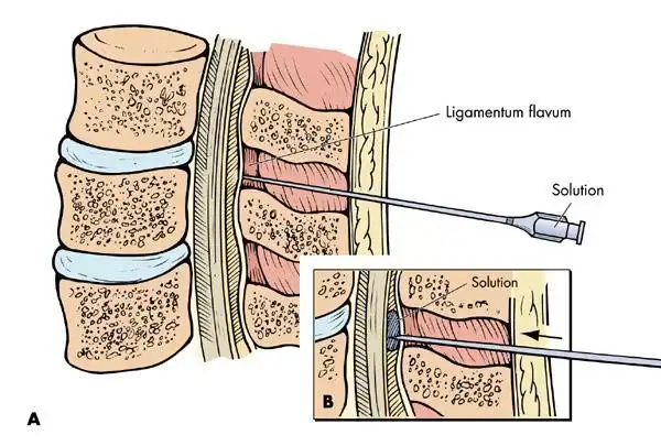 高龄腰椎疼痛可尝试骶管封闭术
