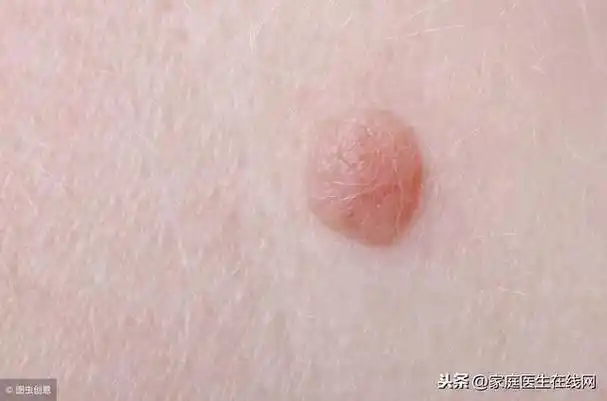 长了扁平疣怎么办?试试3个方法,"消灭"这些小疙瘩