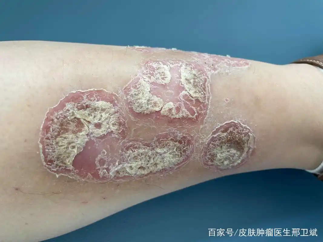 看图识病:银屑病(牛皮癣)