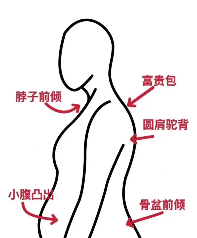 这种体态真的很好改善!快冲.很多公主问我圆肩驼背富贵包 - 抖音