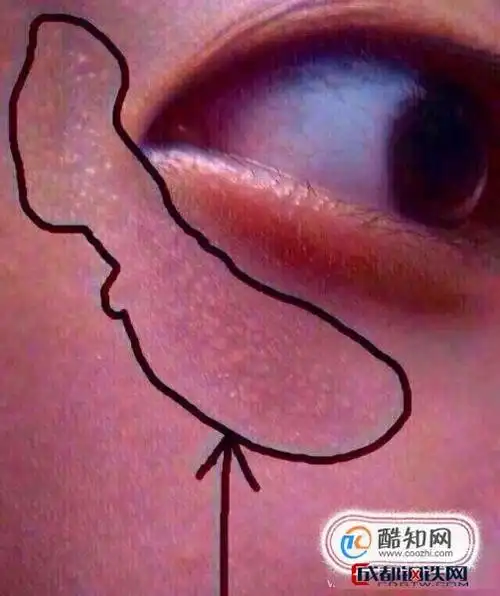 扁平疣和汗管瘤脂肪粒鉴别办法眼睑下长疙瘩