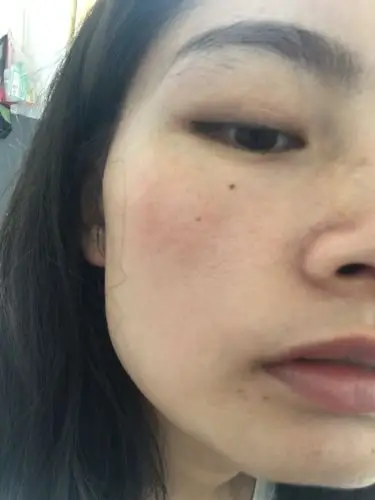 皮肤暗沉有红血丝 同时毛孔也大[大哭]皮肤已经出现了小细纹.