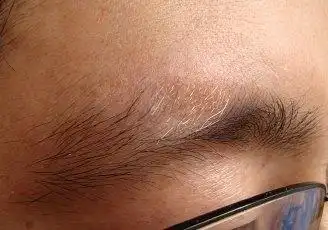 眉部毛发变白白癜风病例展示