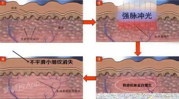 (光子嫩肤原理图)