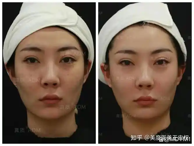 鼻基底凹陷填充对比照-王忠权 - 知乎
