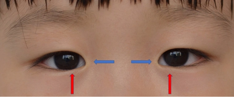 睫毛"倒着长"!这种先天性眼部疾患容易被家长忽视!