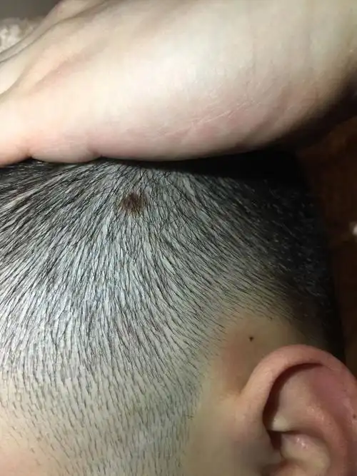 这个头上的是痣吗?严重不?