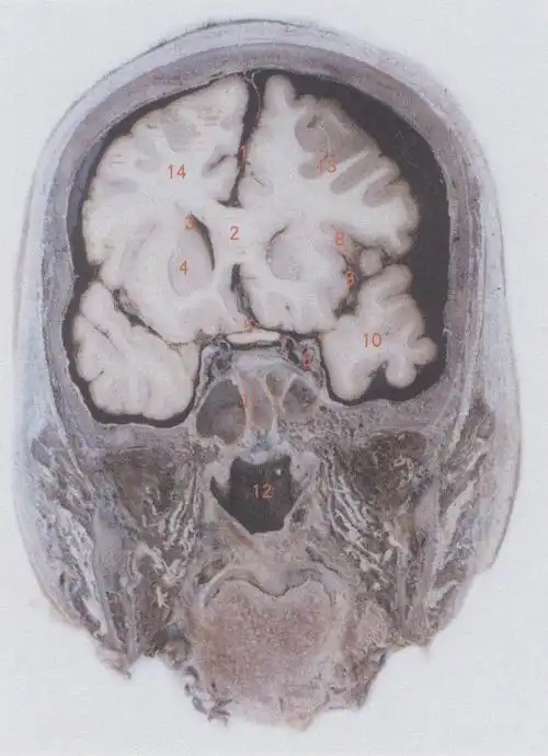 1大脑镰cerebralfalx2胼胝体corpuscallosurn3侧脑室lateralventricle