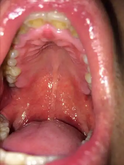 口腔有小颗粒不疼不痒,请问是念珠菌感染吗?念珠菌感染什么症状?