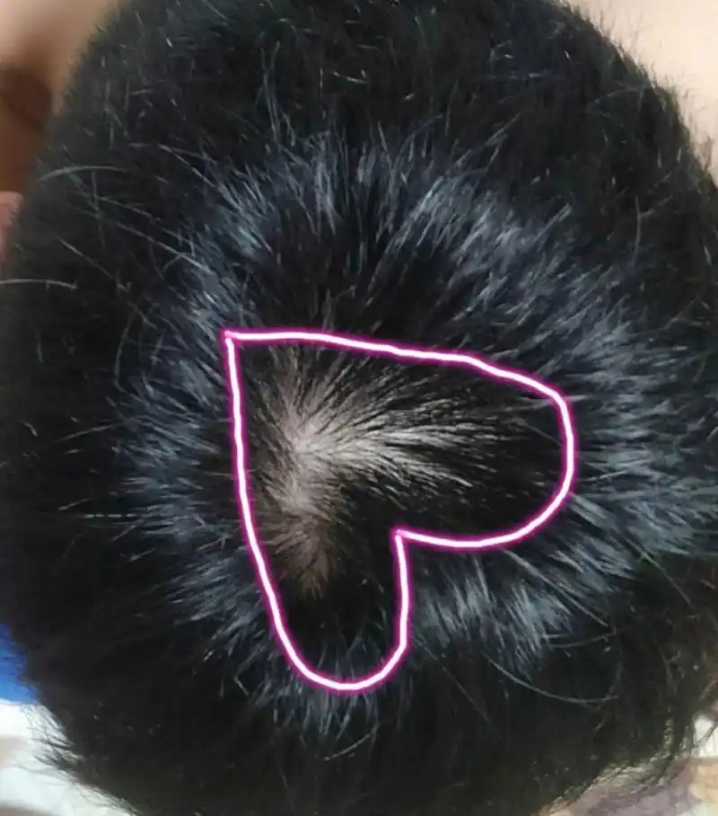 头顶发旋越来越秃该怎么办 现在发旋附近的头发感觉越来越少了,怎么办