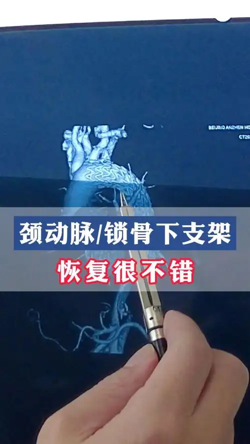 颈动脉和锁骨下动脉放支架,恢复不错