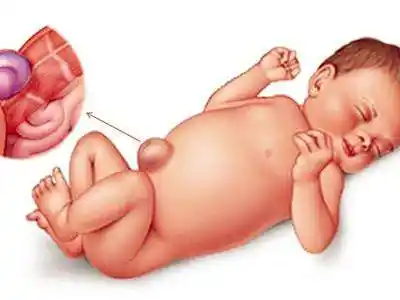 "疝气"到底是什么鬼?宝宝会不会很难受?_腹股沟