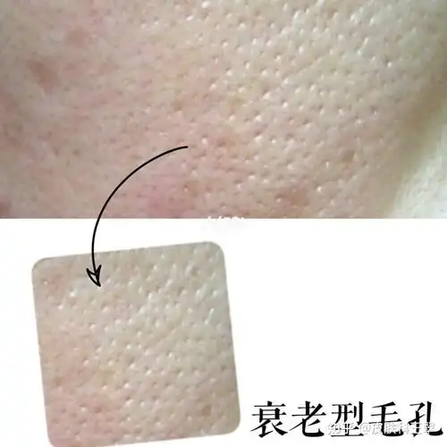 毛孔粗大的原因