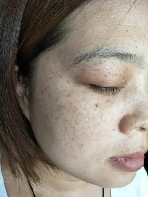 我的雀斑会遗传给孩子吗?