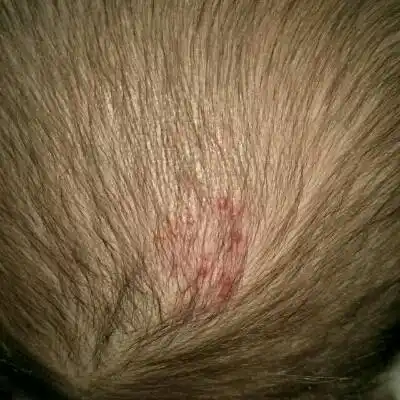 现在有点长了,如果是血管瘤要怎么治疗法,要多大治疗_宝宝树