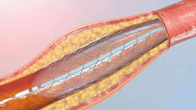 动脉支架,是心脏介入手术中常用的医疗器械,具有疏通动脉血管的作用