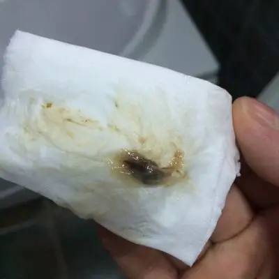 最开始是白带里带非常零星的咖啡色血丝,现在常有这种黑褐色分泌物