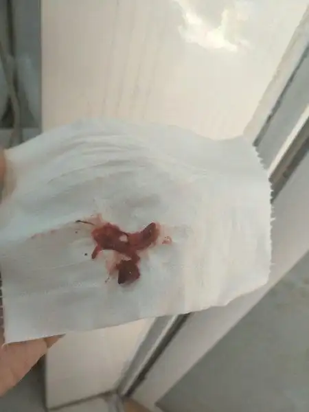 怀孕38天,自然流产排出这个东西,请问有知道这是什么的吗?