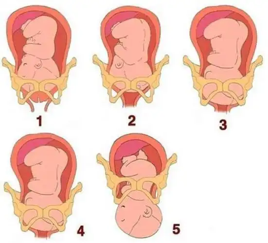 "慢性子"胎儿剖出,医生差点被熏吐,产妇:傻等入盆差点害了娃