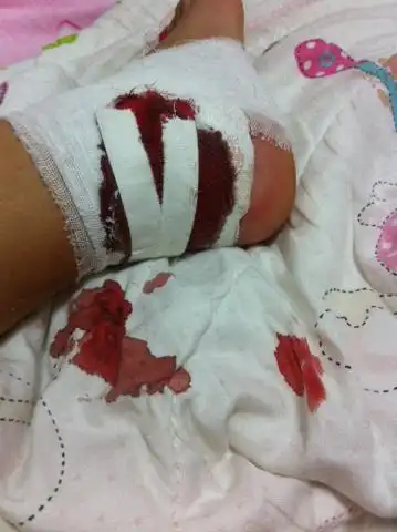 脚后跟受伤 缝了五六针一个小时后一直流血,现在发烧了怎么办?