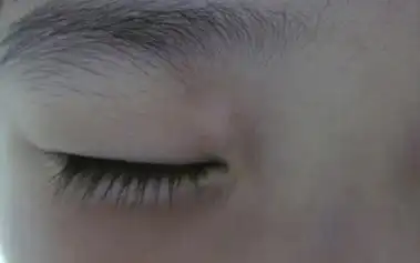 远大医生回复:"宝宝皮肤保护能力较差,眼角处的白斑白点有很多疾病都