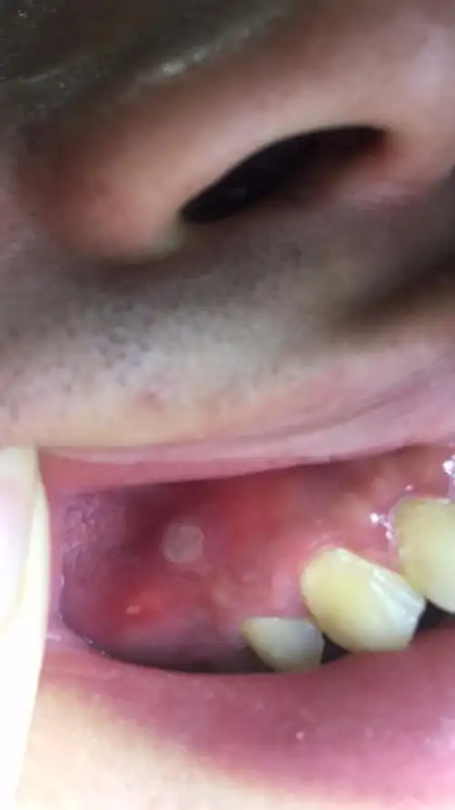 这个是口腔溃疡吗?3个包!