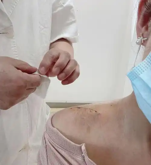 锁骨骨折内固定手术满半月啦