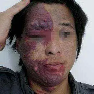 罕见胎记: 左脸青, 右脸红