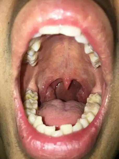 一个正常人的喉咙图片