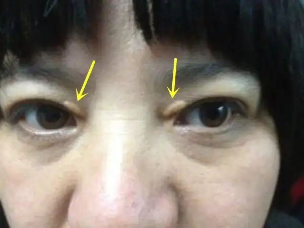 当出现「这些」症状,小心血脂要升高了!