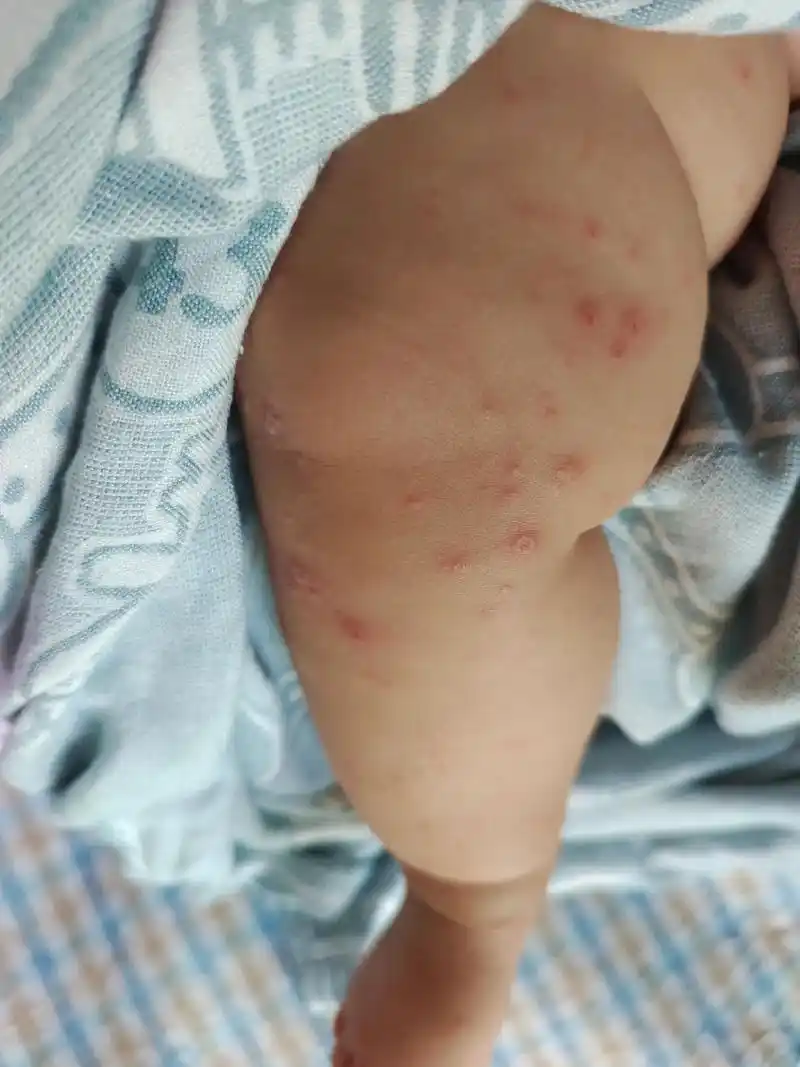 手足口病 这个病毒04就是这么牛,趁孩子睡着拍了几张照片, - 抖音