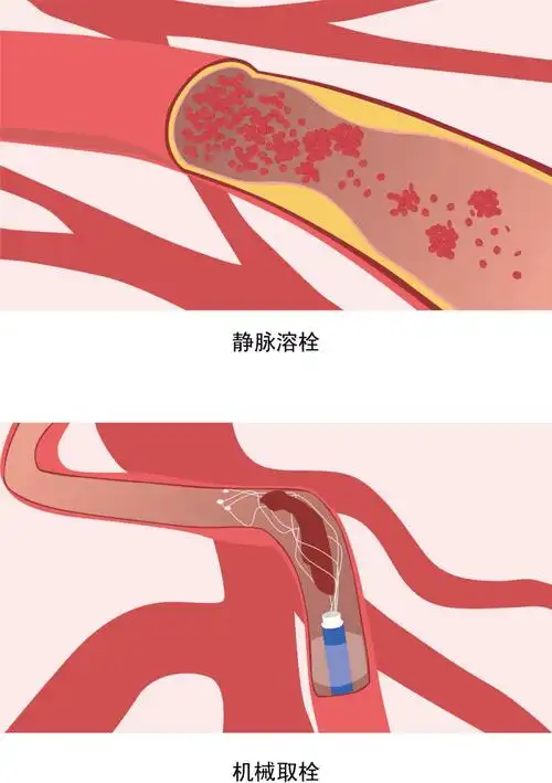 临床上,血管再通治疗主要采取静脉溶栓药物治疗和血管内机械取栓治疗