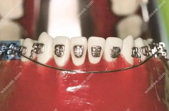 正畸摇椅弓的作用与功效都在这儿了!