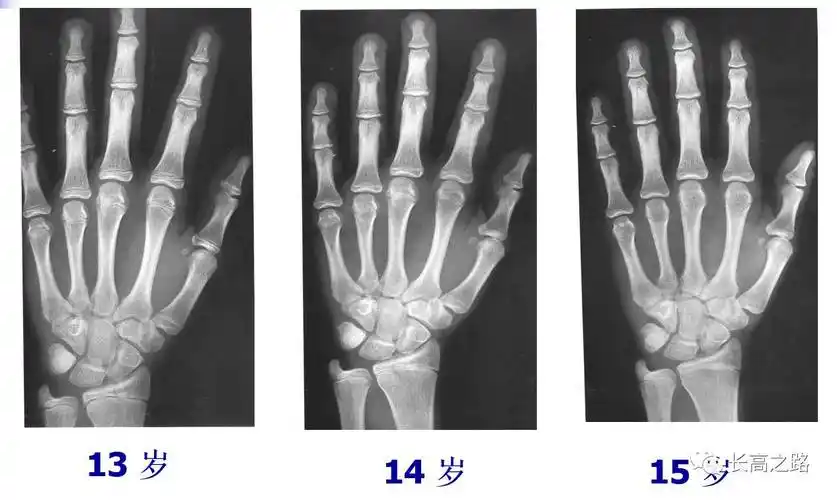 教你简单识别孩子的骨龄片