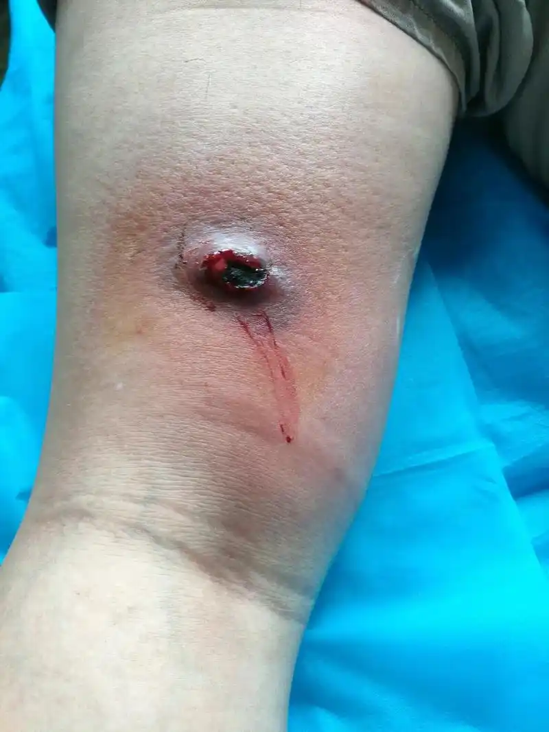 炎热的夏天是毛囊炎(痈,疖)的高发季节,千万不要挤,抠等,更 - 抖音