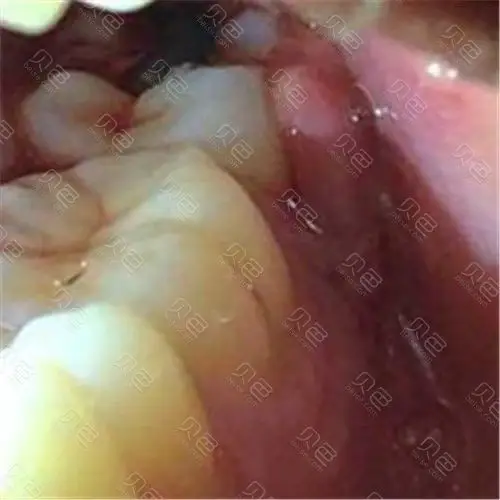 牙槽里边的软肉肿痛