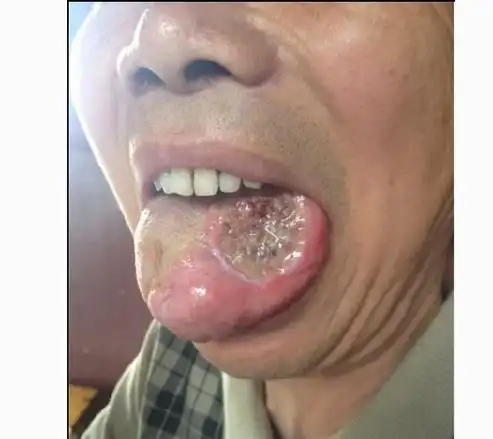 轻微舌癌图片 (28)_有来医生
