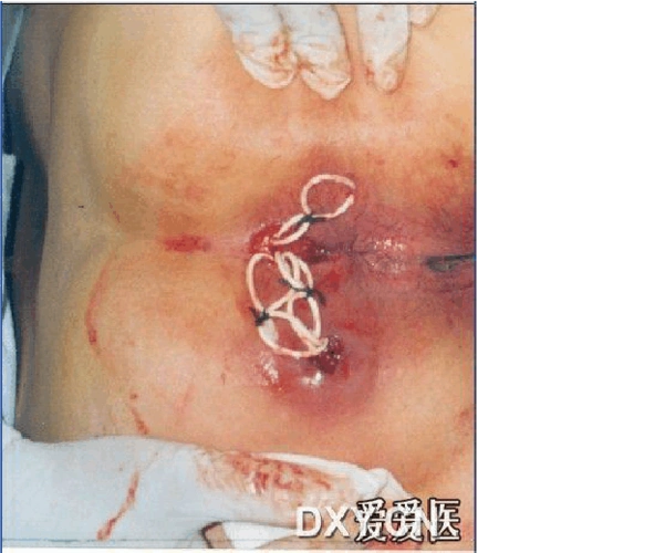 肛周脓肿手术 病历模板 混合痔临床路径 中医肛肠科 肛门直肠周围脓肿