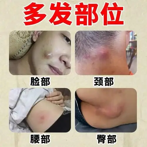 治火疖子拔毒拔脓膏神器屁股c硬块红肿火疖子拔脓膏贴火疖子药膏