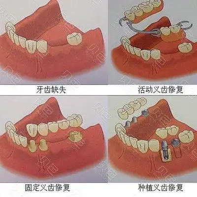 三种常用修复方式汇总!