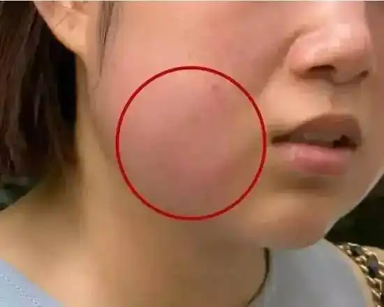 记者暗访曝光|微整形美容针变"毁容真"!