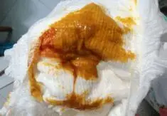 一般急性起病,可伴有发热,高热甚至热性惊厥,腹泻频繁,大便呈粘液状