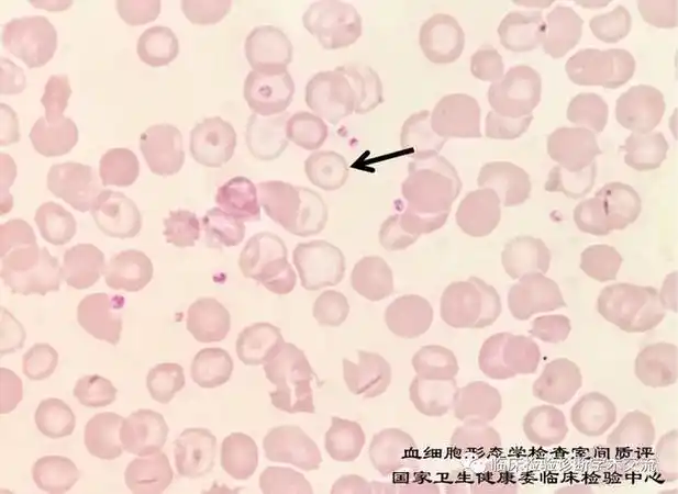 卫健委临检中心2020年血细胞形态学检查室间质量评价及答案|红细胞
