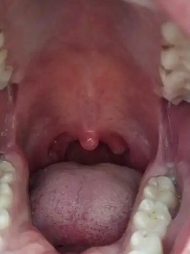 扁桃体旁边长了个肉疙瘩是怎么回事 该怎么消除掉