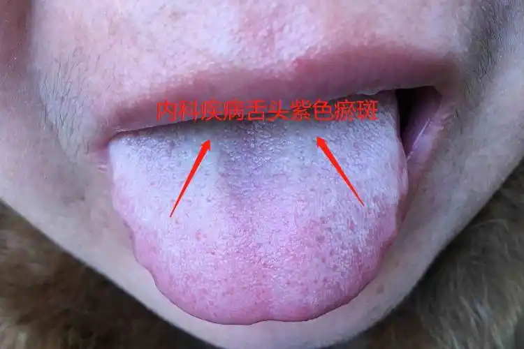 内科疾病舌头紫色瘀斑