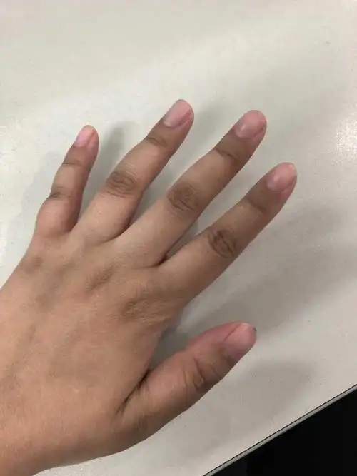女生手指关节发黑何解决?